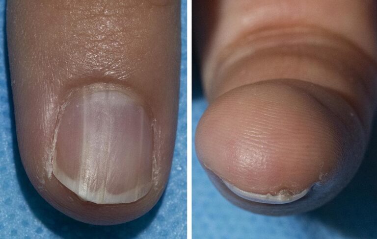 A fingernail with onychopapilloma.Dermatology Consultation Service, NIAMS