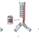 Robotic intrathoracic (chest cavity) cancer surgery