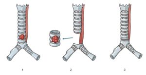 Robotic intrathoracic (chest cavity) cancer surgery