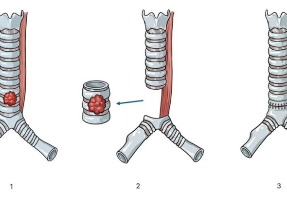 Robotic intrathoracic (chest cavity) cancer surgery