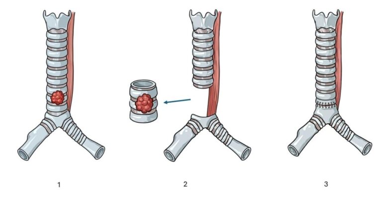 Robotic intrathoracic (chest cavity) cancer surgery