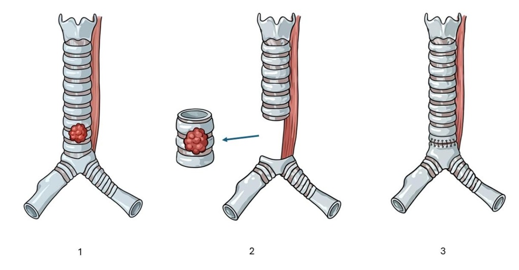Robotic intrathoracic (chest cavity) cancer surgery
